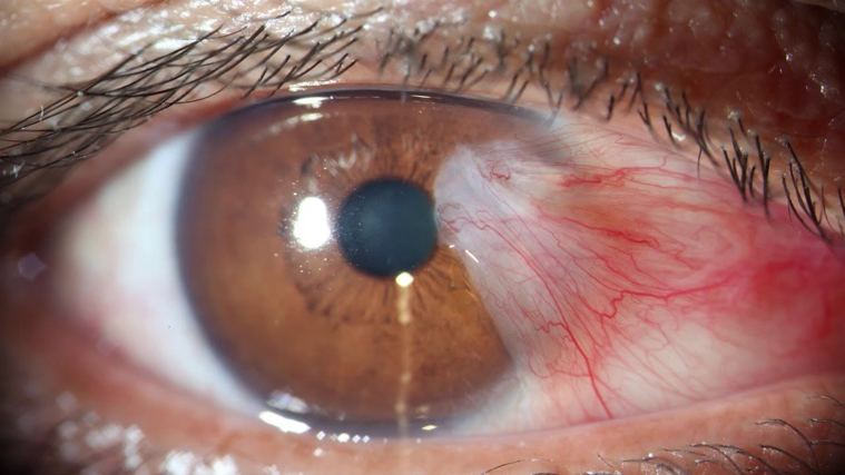 Closeup of a patient's eye with a pterygium