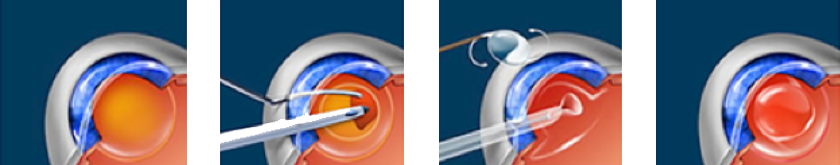 Cataracts Diagram