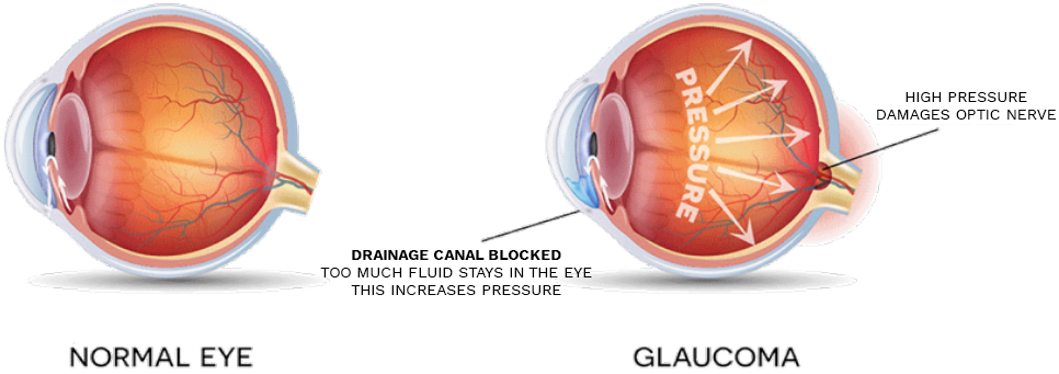 Normal Eye Vs. Glaucoma