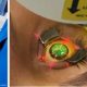 Keratoconus Treatment Images in a collage