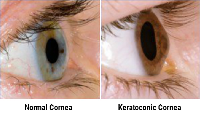 Normal Cornea Vs. Keratoconic Cornea