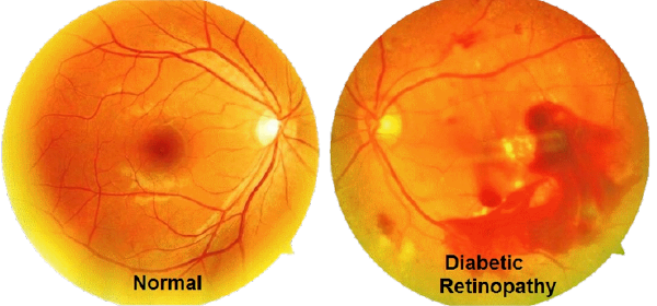 Diabetic Retinopothy