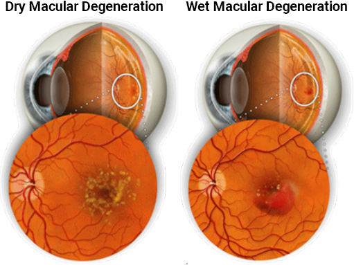 Dry and wet macular degeration