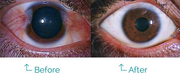 Can a Pterygium | Carnosidad Grow Back After Removal? - Visionary Eye Doctors Can a Pterygium | Carnosidad Grow Back After Removal? - Visionary Eye Doctors