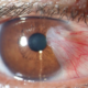 Closeup of a patient's eye with a pterygium