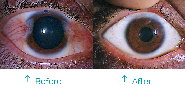 A closeup of pterygium before and after surgery for removal