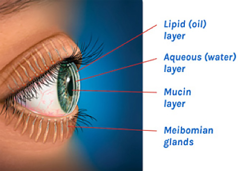 dry eye diagram