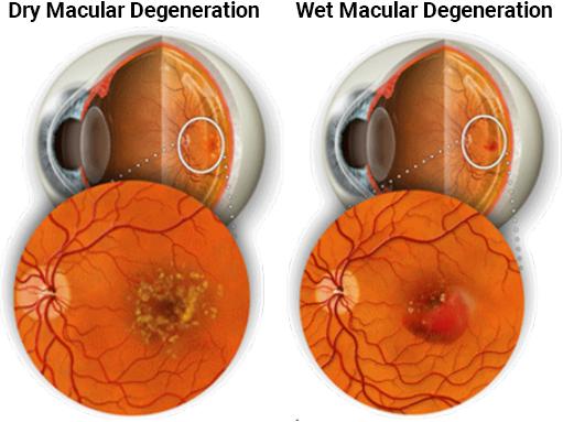 Dry Macular Degeneration diagram and Wet Macular Degeneration diagram