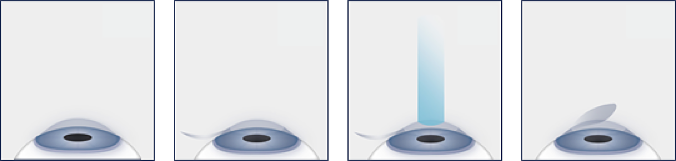 steps of LASIK diagram