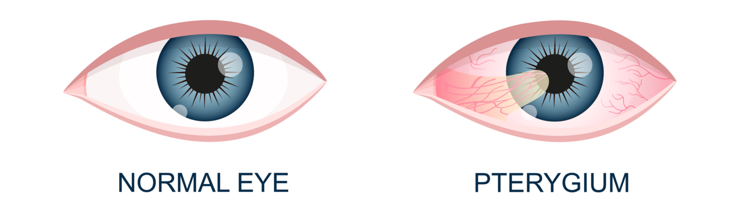 Eye healthy and with pterygium. Conjunctival degeneration before and after surgery. Eye disease. Human organ of vision with pathology. Vector realistic illustration.