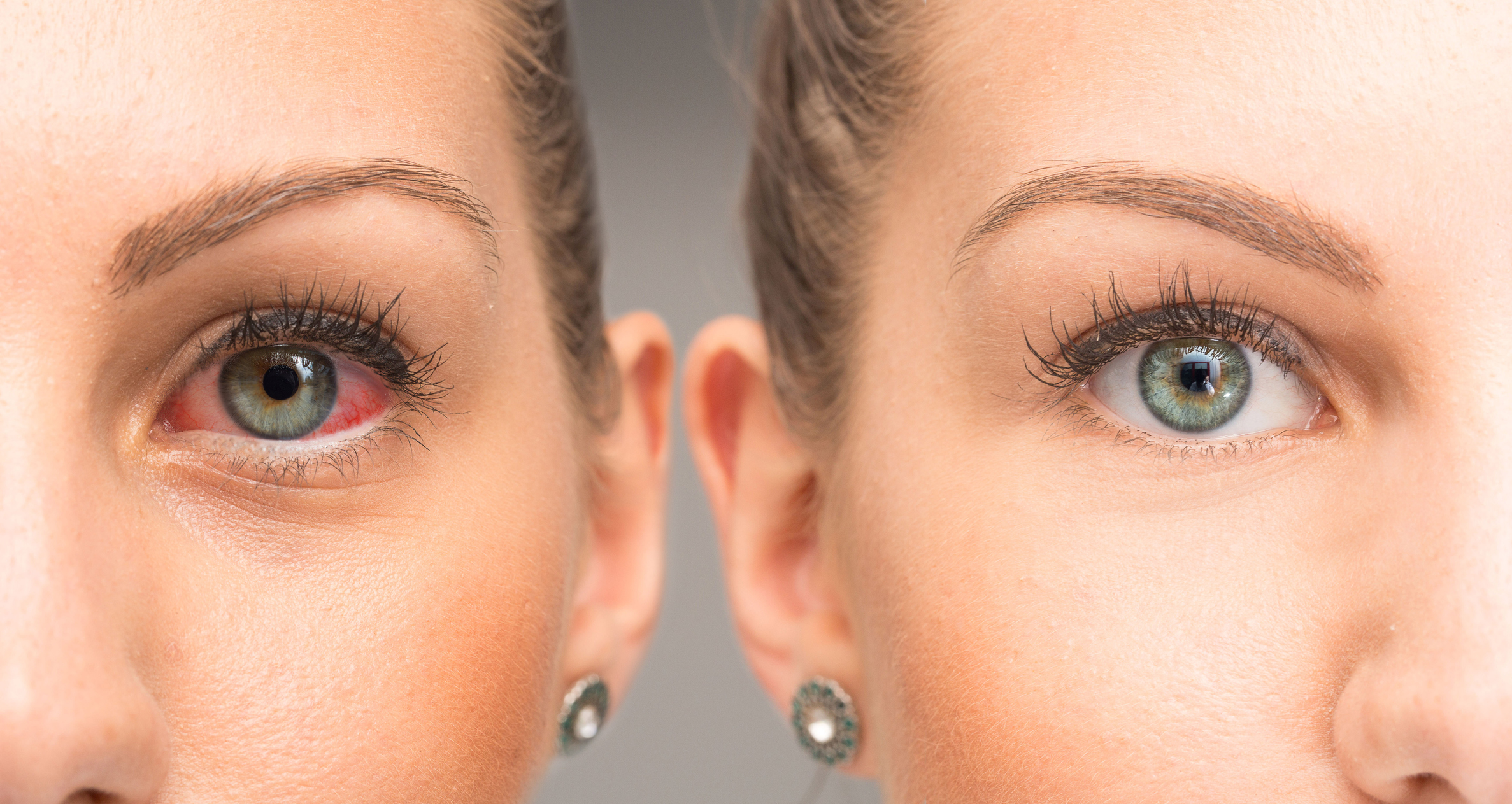 Pink Eye vs Scratched Cornea: Understanding the Differences Pink Eye vs Scratched Cornea: Understanding the Differences