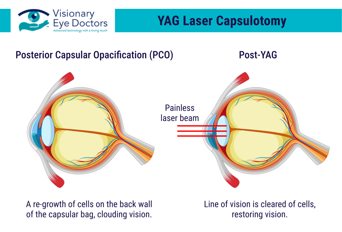 YAG surgery outlined in an infographic