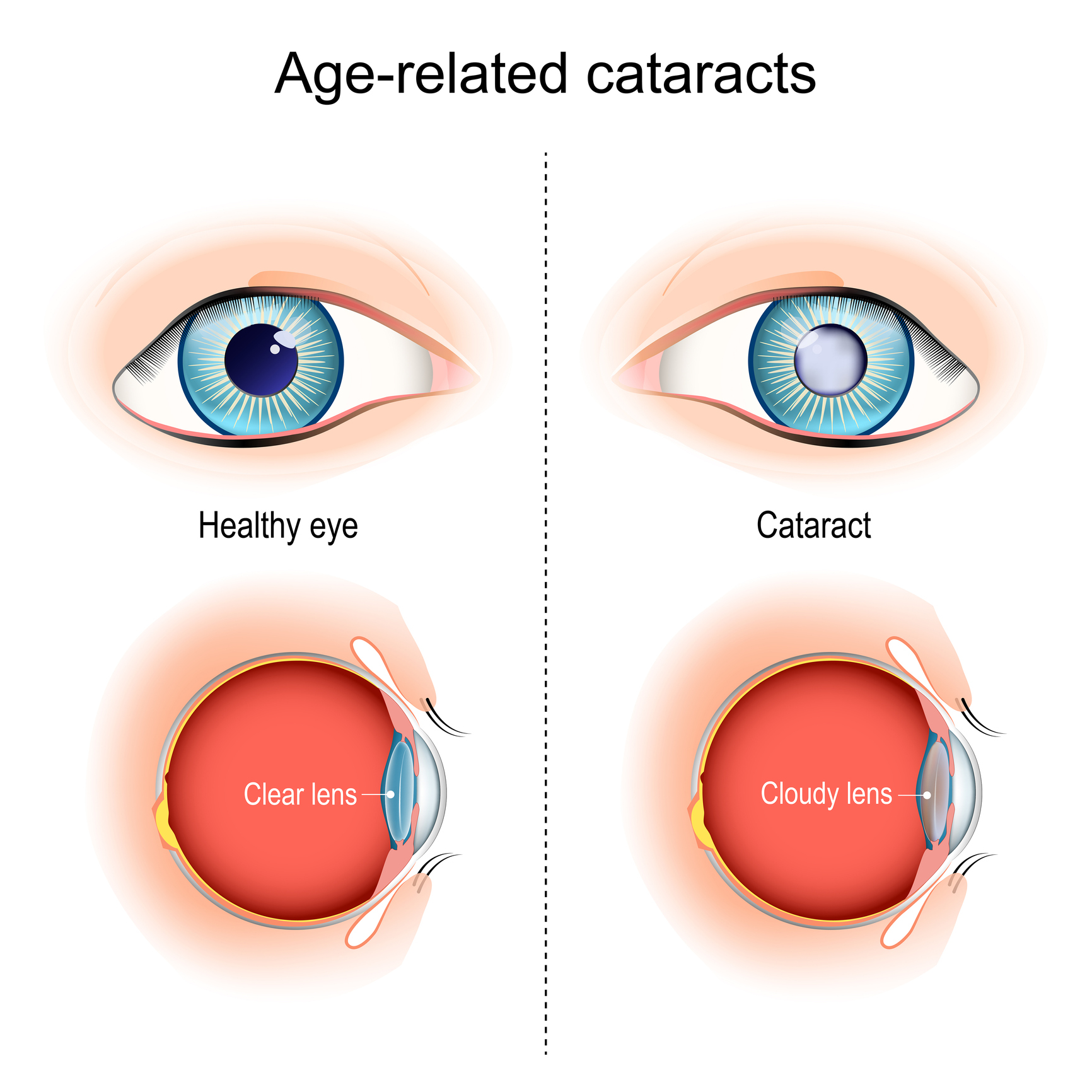 cataracts. Age-related vision problems. Cross-sectional view, showing the position of the human lens. vector illustration