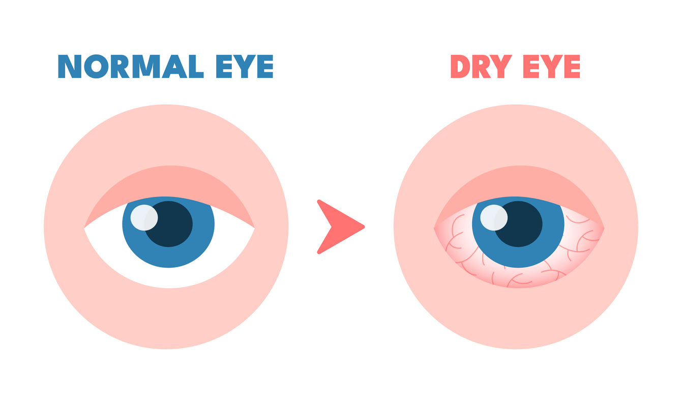 Dry eyes. Healthy unhealthy red eye, driing astonished redness irritated surface eyeball, conjunctivitis glaucoma disease or lens allergies, optometry concept vector illustration