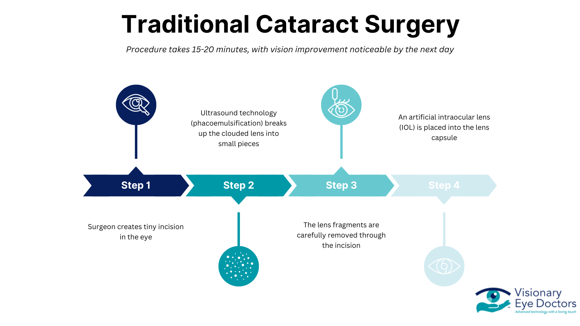 Infographic describing the steps of a traditional cataract surgery.