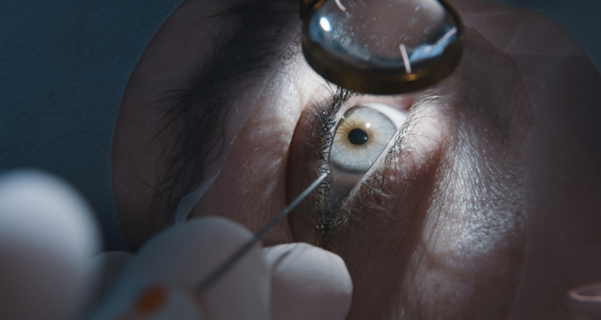 Close up of a patient receiving cataract surgery.
