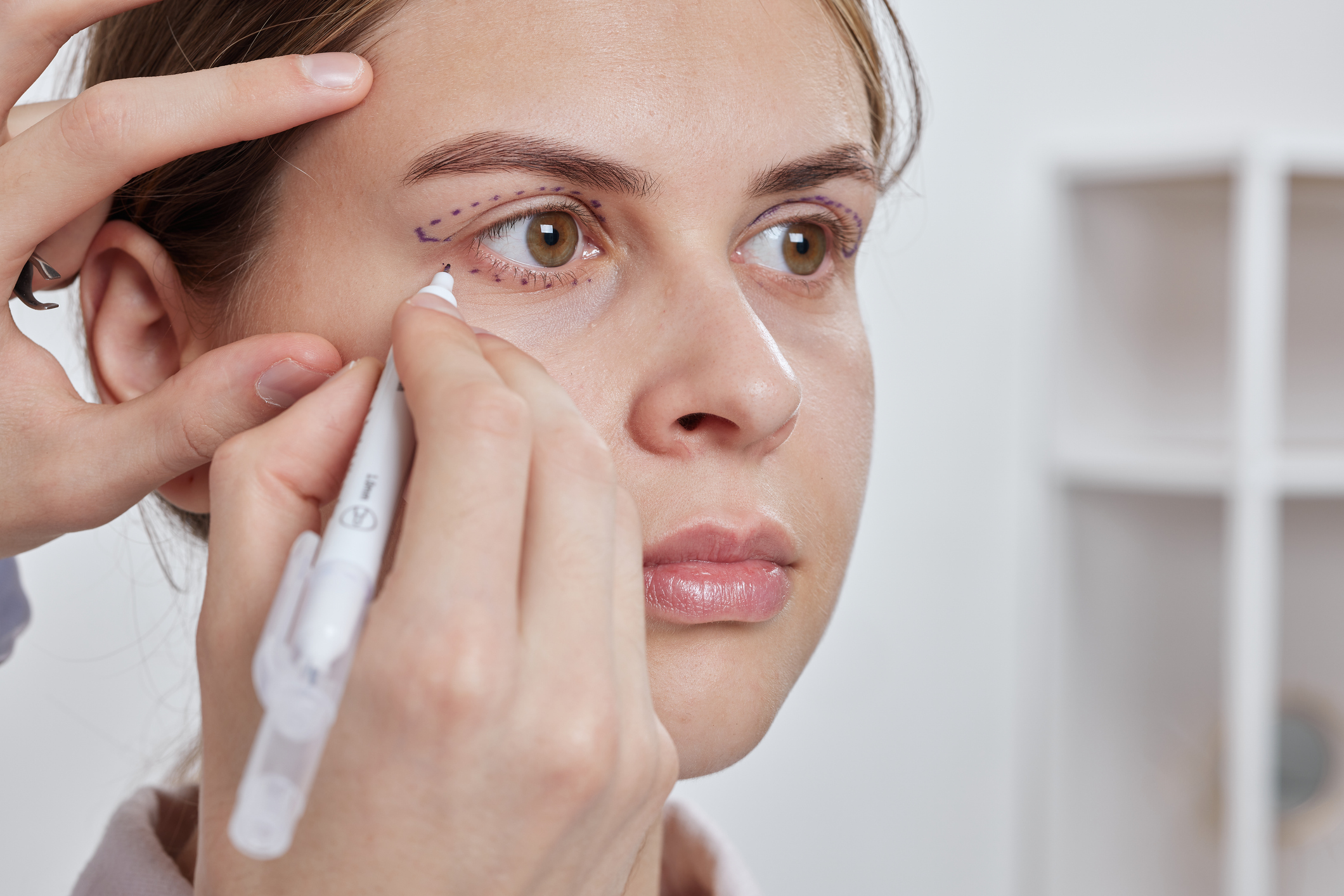 Picture of someone being prepared for eyelid surgery