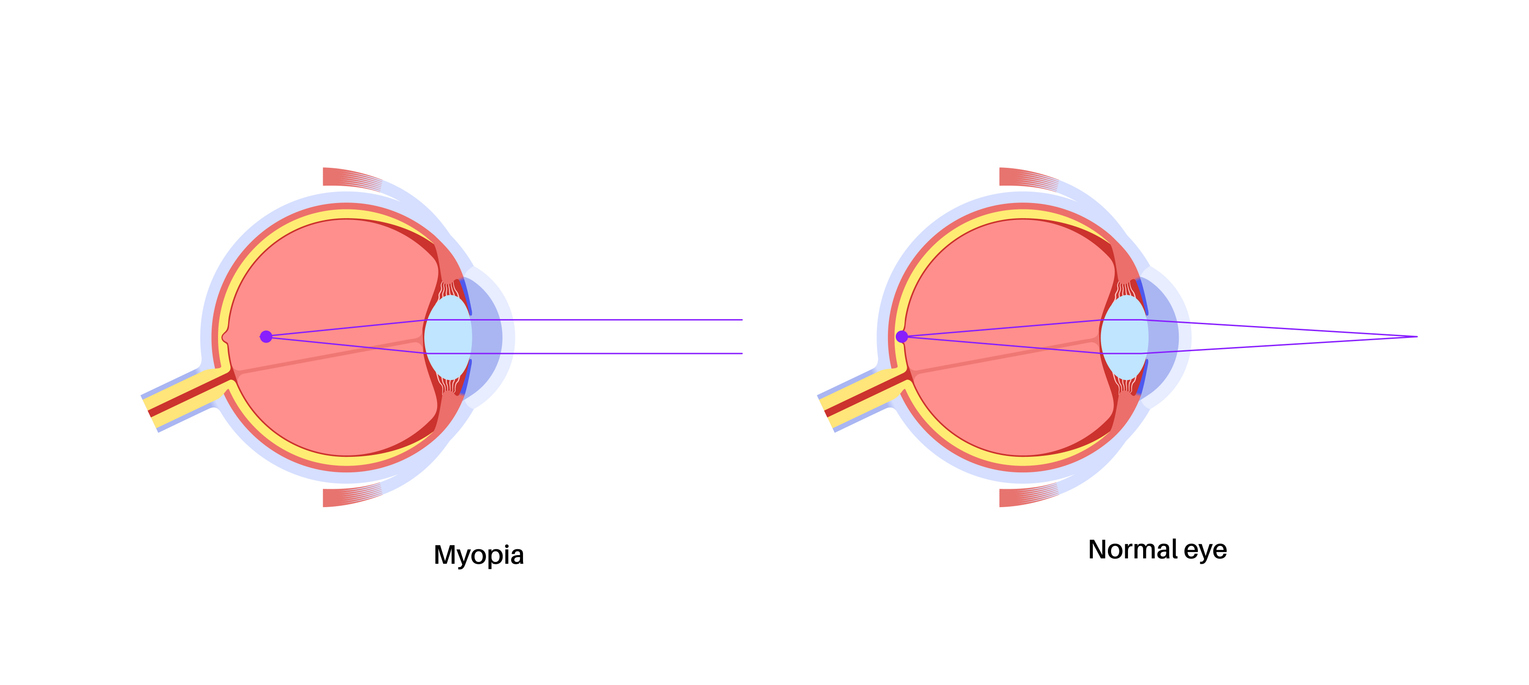 Normal eye and myopia