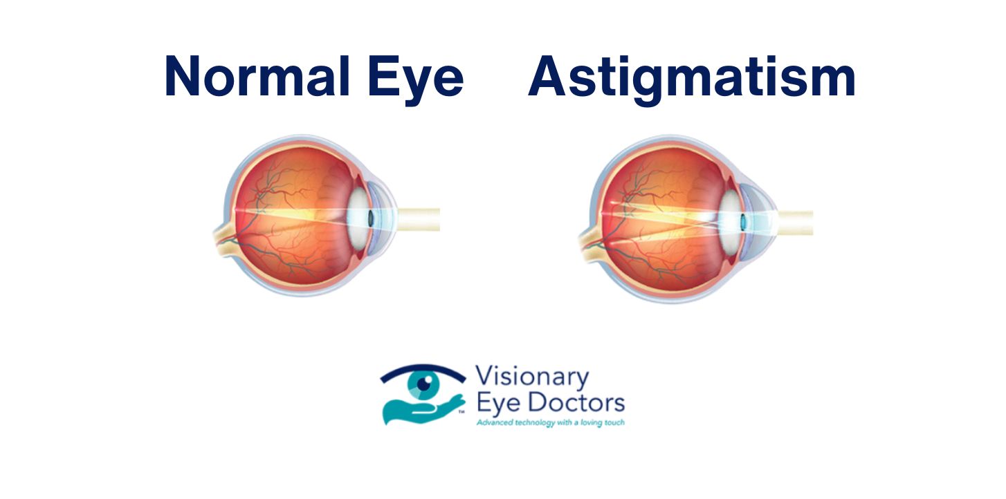 infographic comparing a normal eye to astigmatism