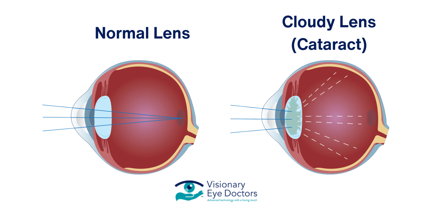 Normal lens vs cloudy lens (cataract)