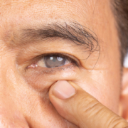 Senior man has cataract. Generally, cataracts are common in older people.