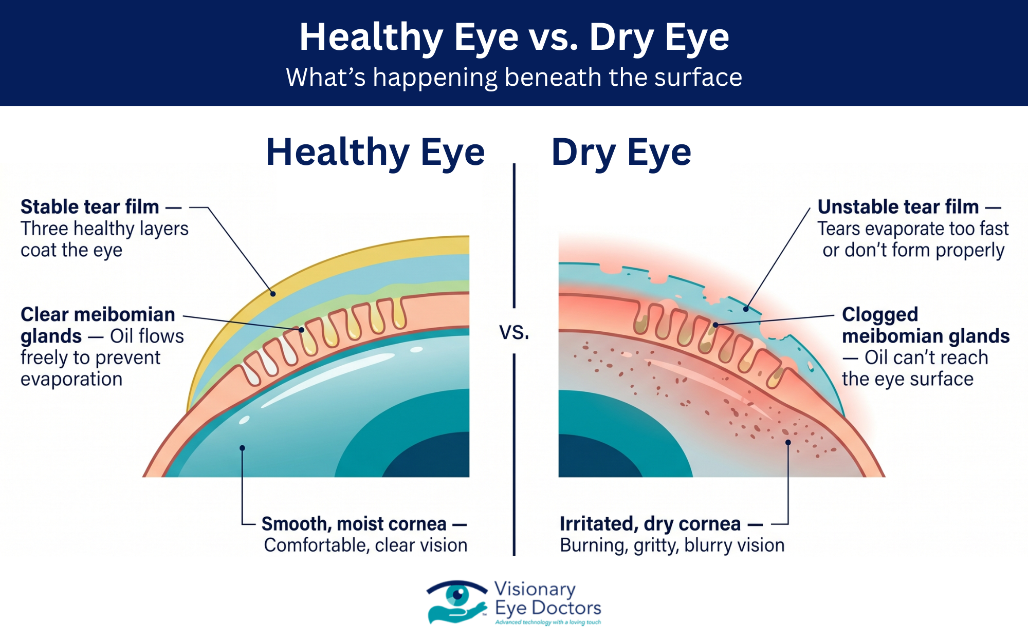 infographic: healthy eye vs dry eye