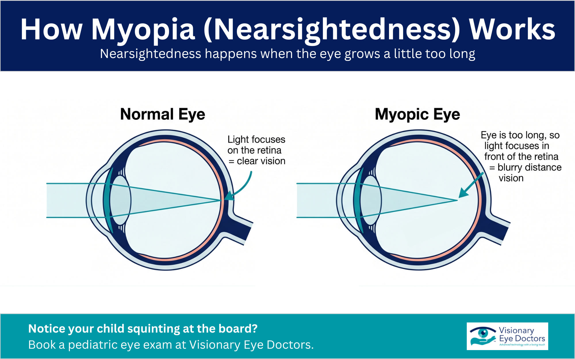 Infographic: How Myopia (Nearsightedness) Works