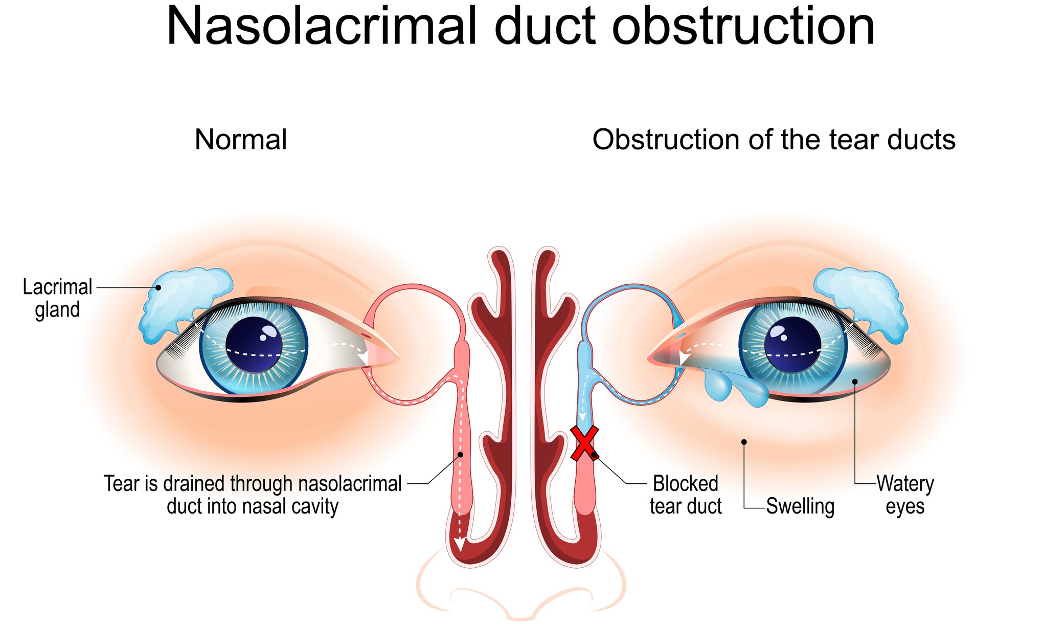 Nasolacrimal duct obstruction. Dacryocystitis. Cross section of Tear ducts. Human eye anatomy. epiphora. Medical diagram. Vector illustration